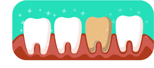 Cáries e problemas com a raiz do dente são mais frequentes. Para combatê-las pode ser necessário fazer uso de cremes dentais específicos;