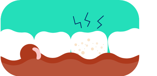 A retração da gengiva pode não só aumentar a sensibilidade dos dentes, como também torná-lo mais vulnerável ao aparecimento de cáries. Uma limpeza bucal adequada pode ajudar a contornar a situação;