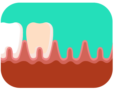 A perda de dentes não é um fator que se relaciona apenas ao envelhecimento. Ainda assim, estima-se que 41,5% dos brasileiros com mais de 60 anos convivem com a perda total ou parcial dos dentes, por isso é importante reforçar os hábitos de higiene bucal e idas frequentes ao dentista.